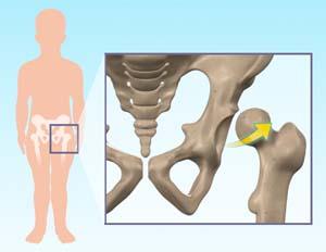 Developmental Dysplasia of the Hip