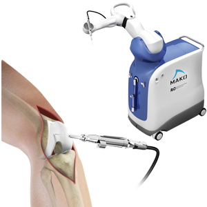 Robotic Knee Replacement